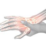 La artritis es una enfermedad inflamatoria autoinmune que produce dolor articular