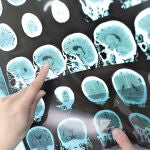 Escaner cerebro. esclerosis múltiple
