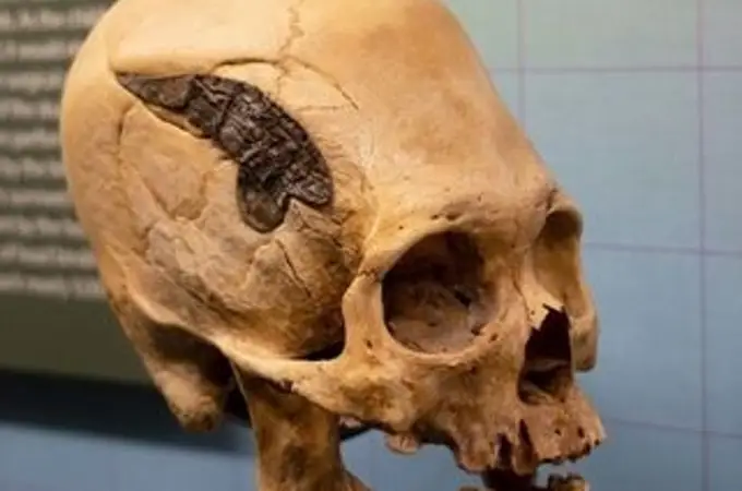 Un cráneo peruano podría ser ejemplo de la primera cirugía realizada en la historia