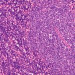 Micrografía de un nodo linfático afectado por leucemia linfocítica crónica