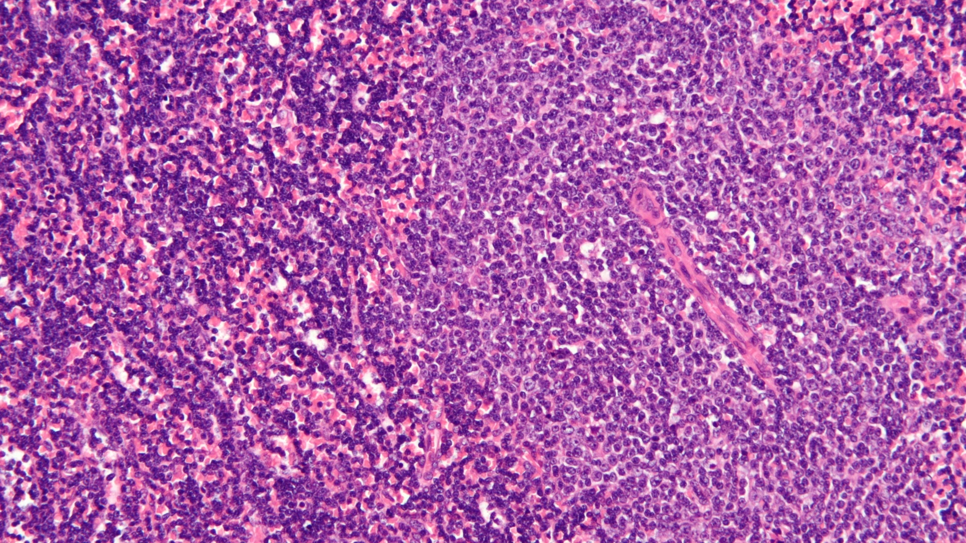 Micrografía de un nodo linfático afectado por leucemia linfocítica crónica