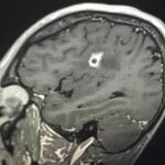 Una mancha oscura en el cerebro de Tyson Bottenus desconcertó a los médicos antes de determinar que se trataba de un hongo.