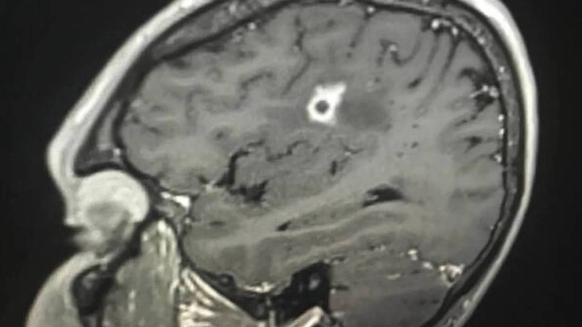 Una mancha oscura en el cerebro de Tyson Bottenus desconcertó a los médicos antes de determinar que se trataba de un hongo.