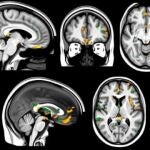 El coronavirus produce una reducción de materia gris en el cerebro