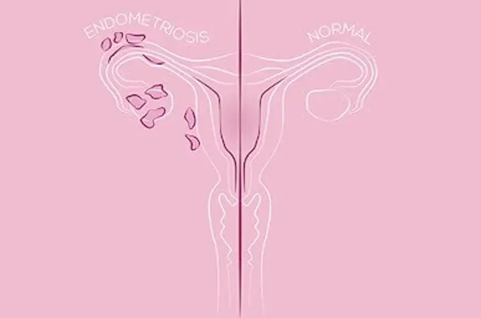 Endofest: el festival que da visibilidad a la endometriosis