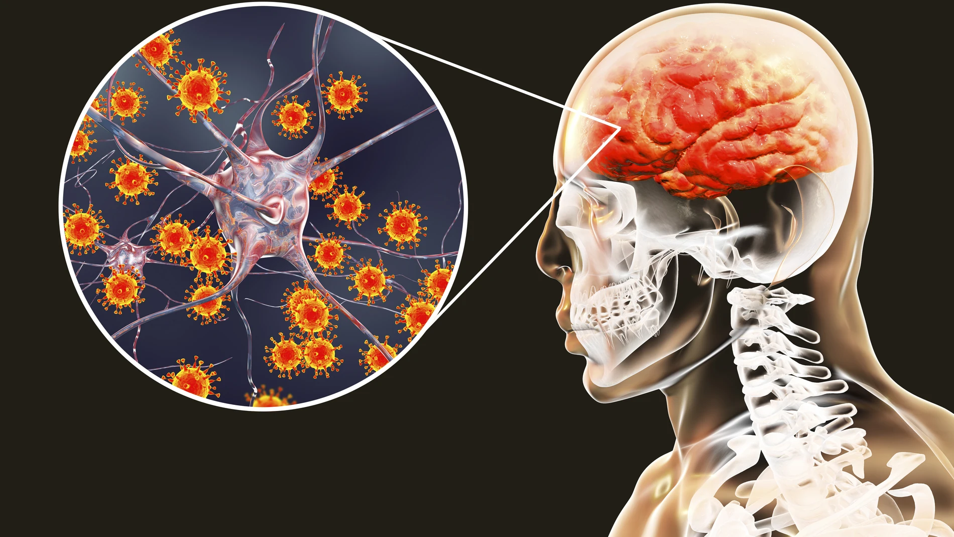 La meningitis es una inflamación de las membranas que recubren el cerebro y la médula espinal