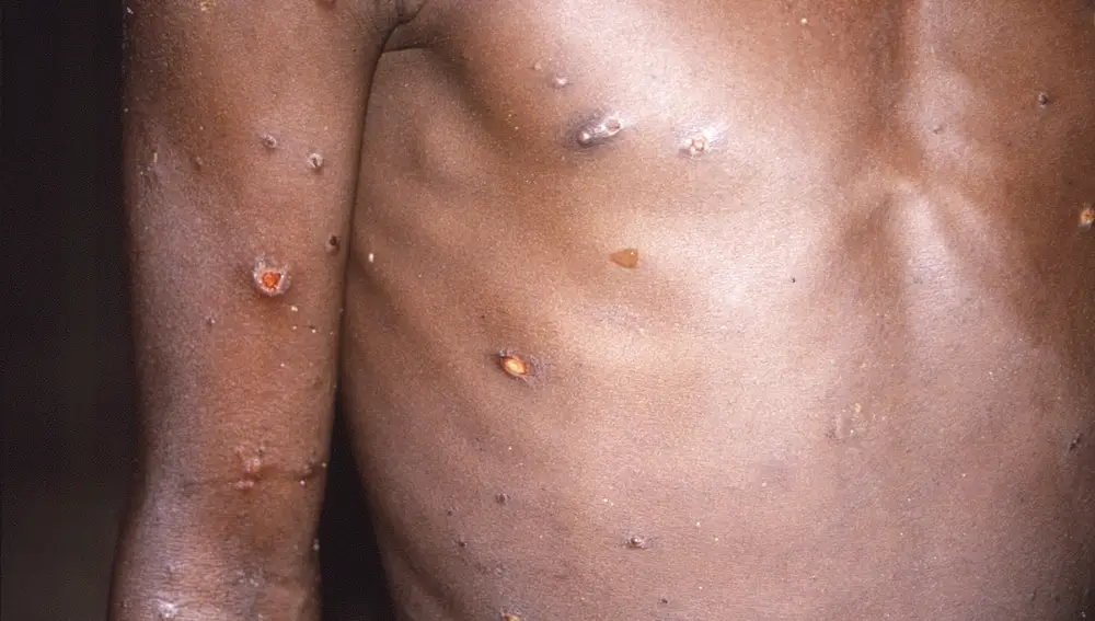 Imagen de 1997 proporcionada por los CDC que muestra el brazo y el torso de un paciente, cuya piel mostraba varias lesiones por la viruela del mono