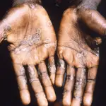 Imagen de las lesiones en la piel provocadas por la viruela del mono.