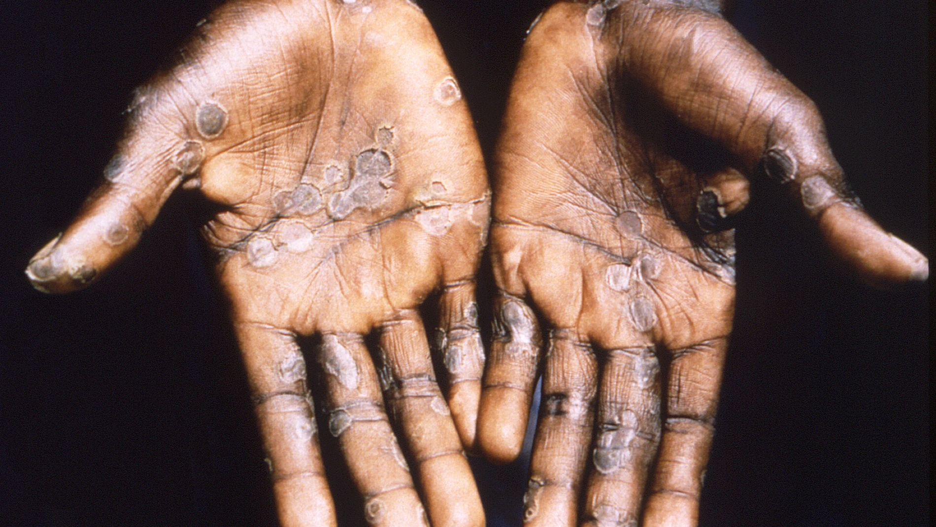 Imagen de las lesiones en la piel provocadas por la viruela del mono.