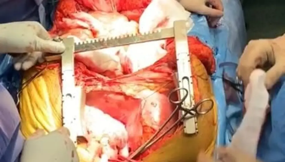 Imagen tomada durante un trasplante cardíaco cedida por el Dr. Rubén Jara (jefe de UCI) y el Dr. Sergio Canovas (jefe de Cirugía Cardiovascular) del Hospital Virgen de la Arrixaca, en la Región de Murcia