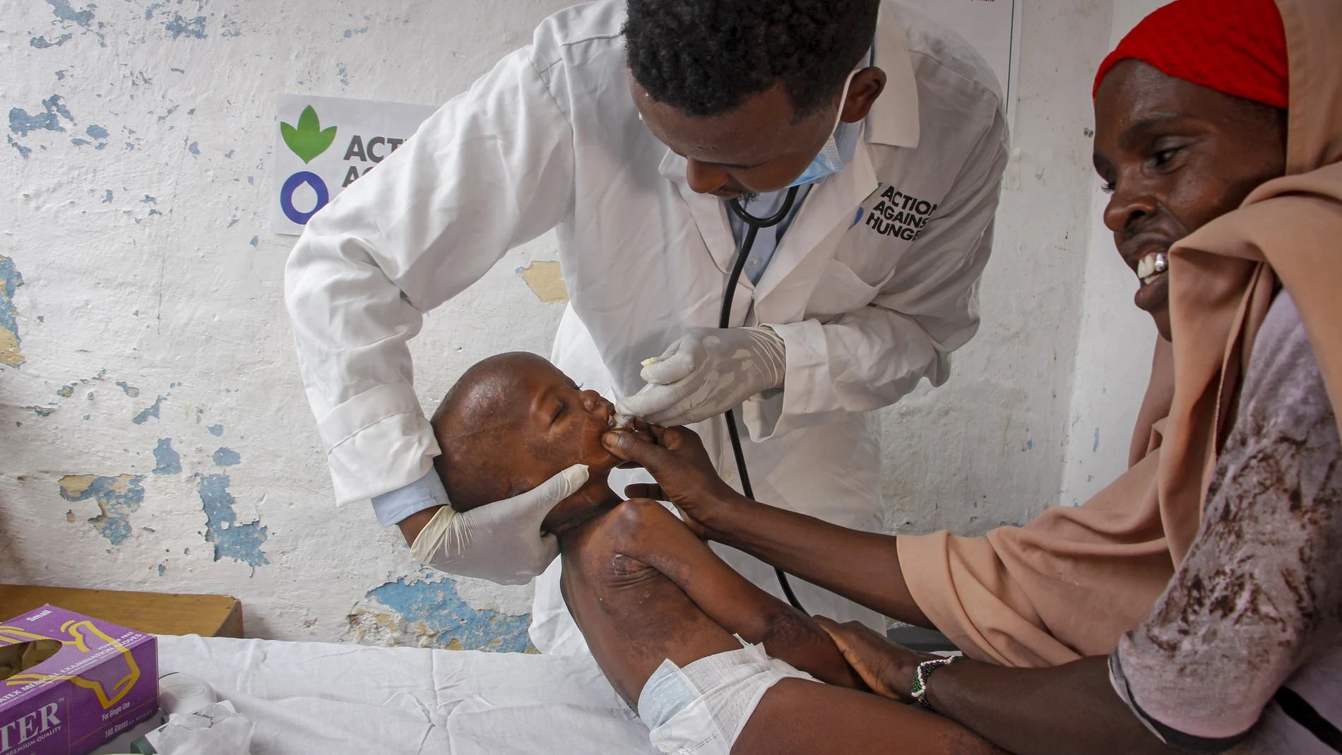Un médico somalí trata a un niño con síntomas de kwashiorkor, una enfermedad originada por la falta de proteínas.