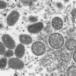 Vista microscópica del virus que causa la viruela del mono