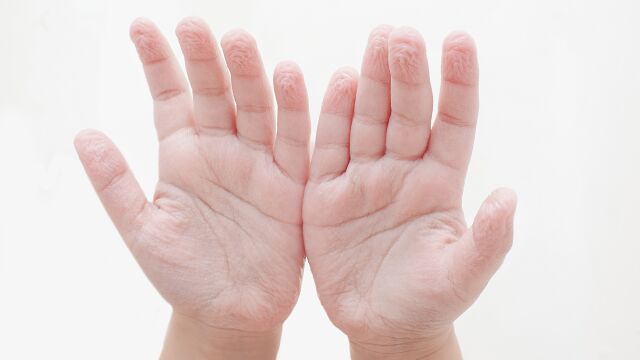 Las palmas de la mano se arrugan después de una larga estancia en el agua | Fuente: Dreamstime