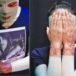 Elena Ríos fue atacada con dos litros de ácido sulfúrico