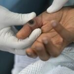 Un médico muestra las lesiones de un paciente causadas por la viruela del mono