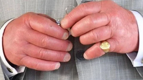 Las manos del rey Carlos II de Inglaterra están muy hinchadas y enrojecidas