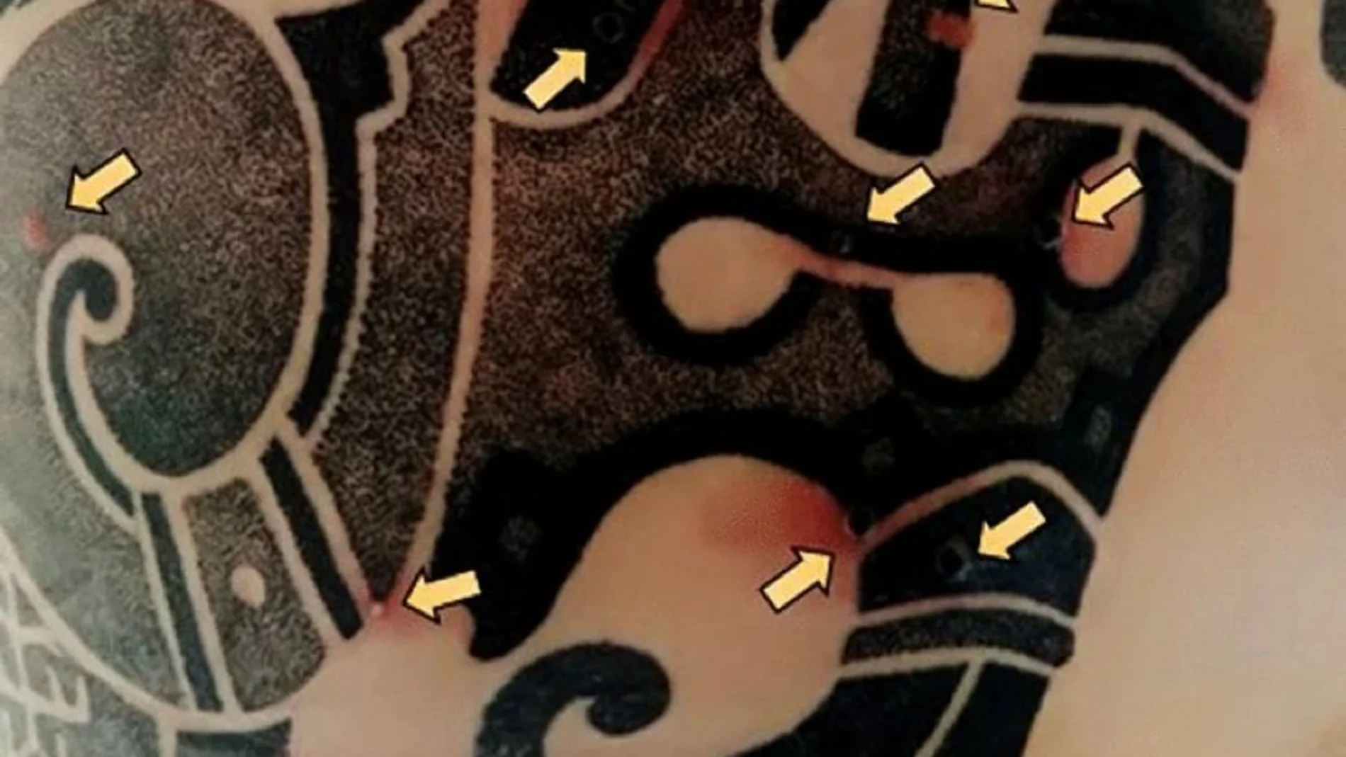 Área de la piel del tatuaje con lesiones de viruela del mono (flechas)