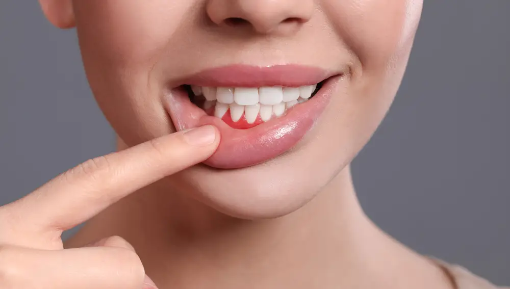 La periodontitis, también llamada enfermedad de las encías, es una grave infección que daña el tejido blando.