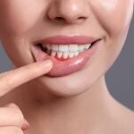 La periodontitis, también llamada enfermedad de las encías, es una grave infección que daña el tejido blando.