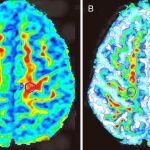Mapas de color de anisotropía fraccional en axial de un sujeto sano (A) y un paciente con ELA (B). En el enfermo se percibe una menor elasticidad cerebral