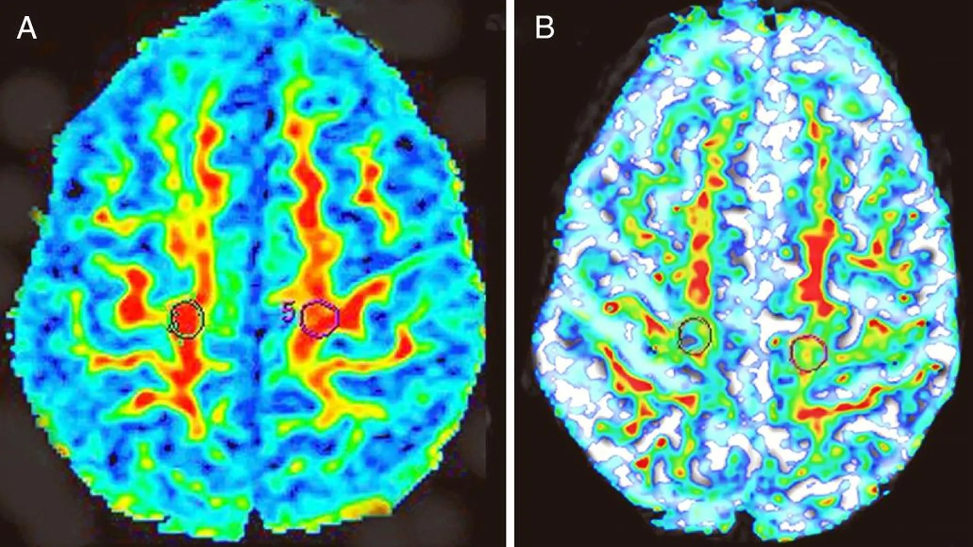 Mapas de color de anisotropía fraccional en axial de un sujeto sano (A) y un paciente con ELA (B). En el enfermo se percibe una menor elasticidad cerebral