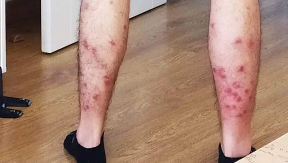 Efectos de la mordedura de la mosca negra en Getafe