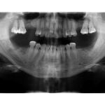 La radiografía dental permite apreciar el impacto causado por algunos tratamientos