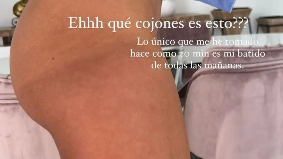 El cuerpo de Sofía Suescun lleno de manchas