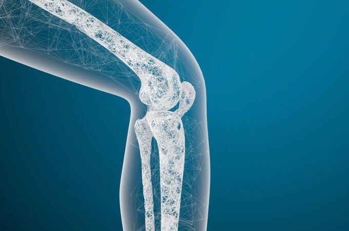 Osteoporosis: qué es y cómo prevenir esta enfermedad ósea