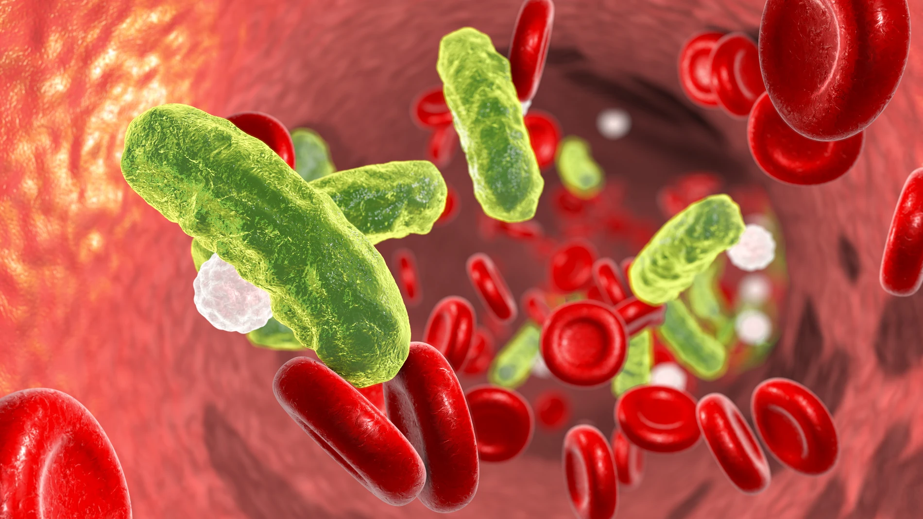 La septicemia es una infección producida por microorganismos patógenos en la sangre