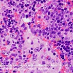 Nuevo trabajo de investigación de la Universidad de Salamanca en la lucha contra el cáncer
