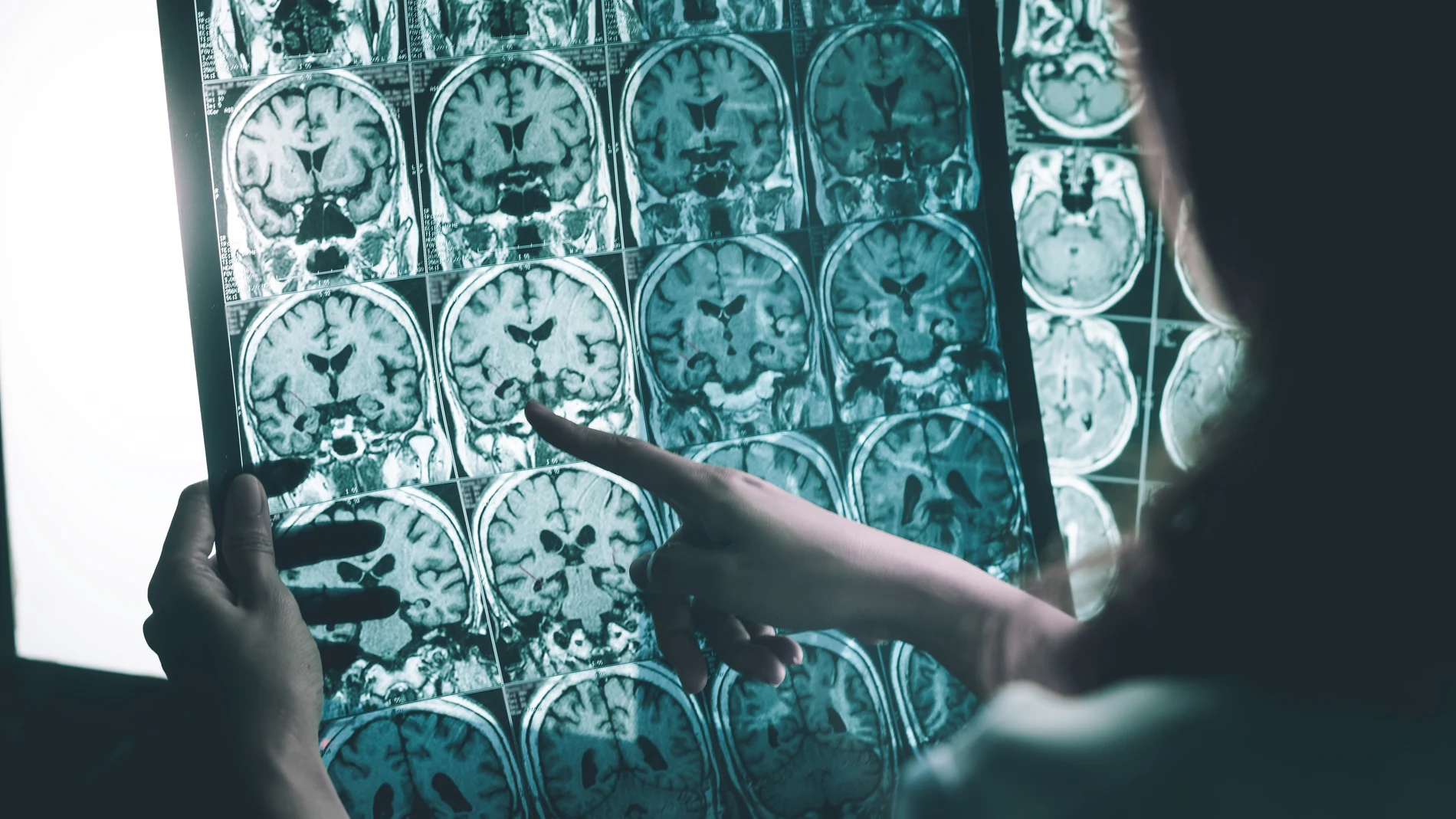 Según nuevos hallazgos haber padecido Covid-19 aumenta el riesgo de padecer Alzheimer