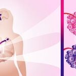 La imagen muestra un tumor primario de cáncer de mama (rosa) y los tumores metastásicos/secundarios (púrpura).