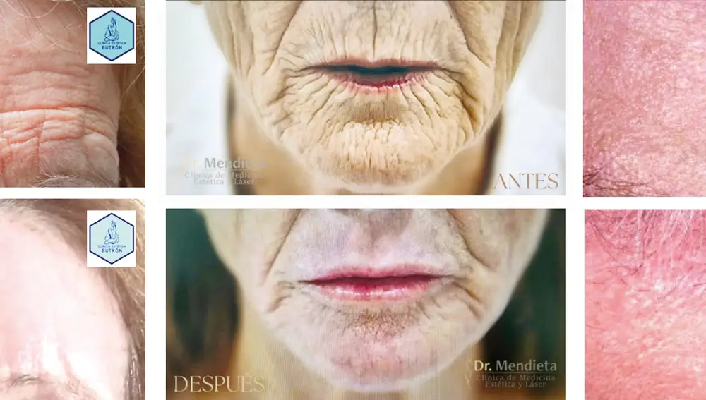 En comparación con otros métodos médico estéticos, los resultados de rejuvenecimiento duran años y no efectuamos modificación de las facciones naturales del rostro.