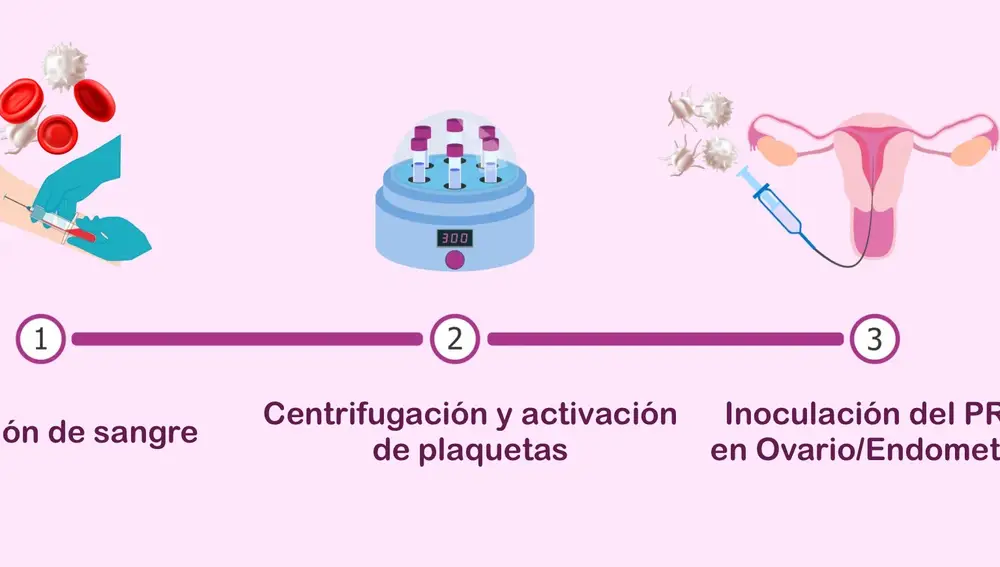 Fallos de implantación en fecundación in vitro, rejuvenecimiento y regeneración endometrial, uterina y ovárica