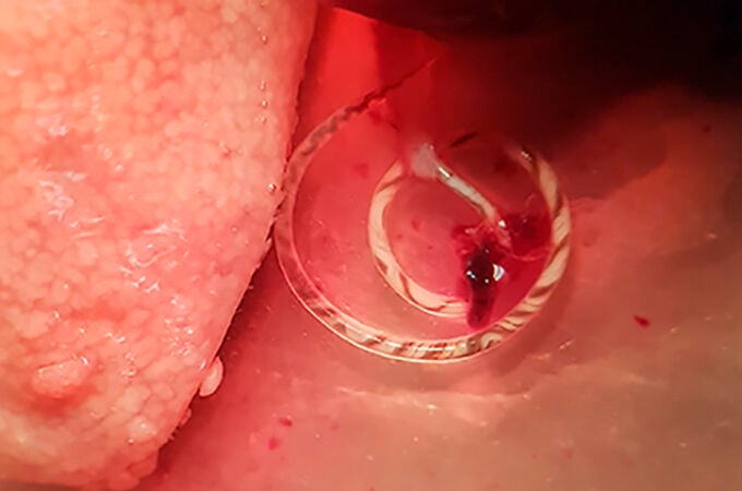 Angiostrongylus cantonensis emergiendo de la arteria pulmonar de una rata capturada en zona de huerta de Valencia. UGR