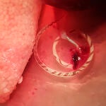 Angiostrongylus cantonensis emergiendo de la arteria pulmonar de una rata capturada en zona de huerta de Valencia. UGR
