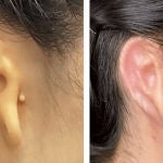 Primer trasplante exitoso de una oreja impresa en 3D
