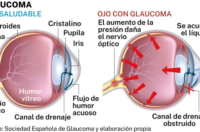 Glaucoma