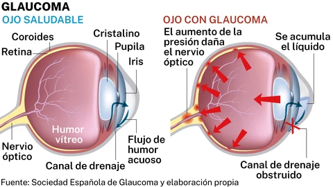 Glaucoma