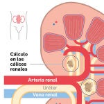 Cálculos en el riñón