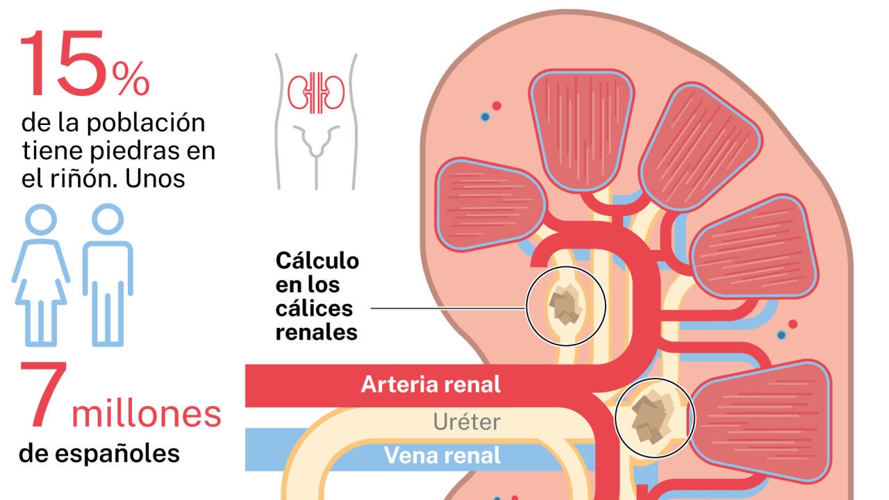 Así es la alimentación que produce más piedras en el riñón