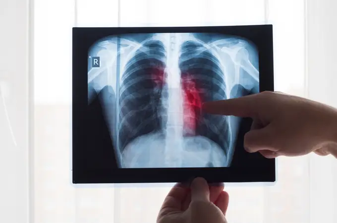 Ingenieros del MIT crean unos sensores inhalables que detectan el cáncer de pulmón