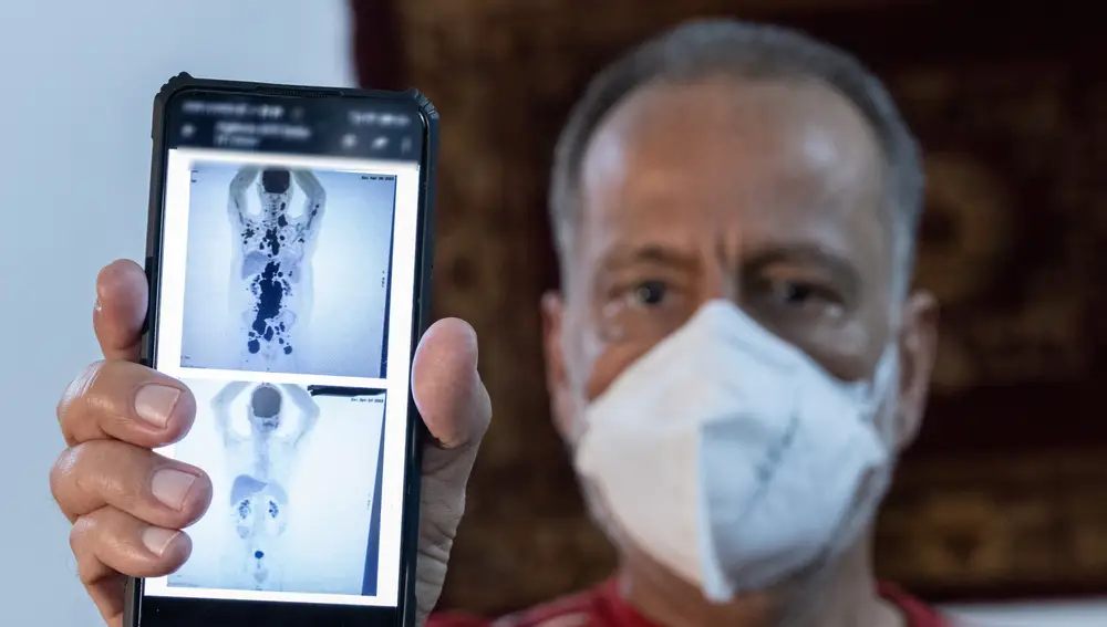 Paulo Peregrino muestra dos resonancias magnéticas de su torso durante una entrevista con EFE, el 5 de junio de 2023. Los estudios experimentales con CAR-T se realizan con fondos públicos a través de la fundación Hemocentro de la Universidad de Sao Paulo 