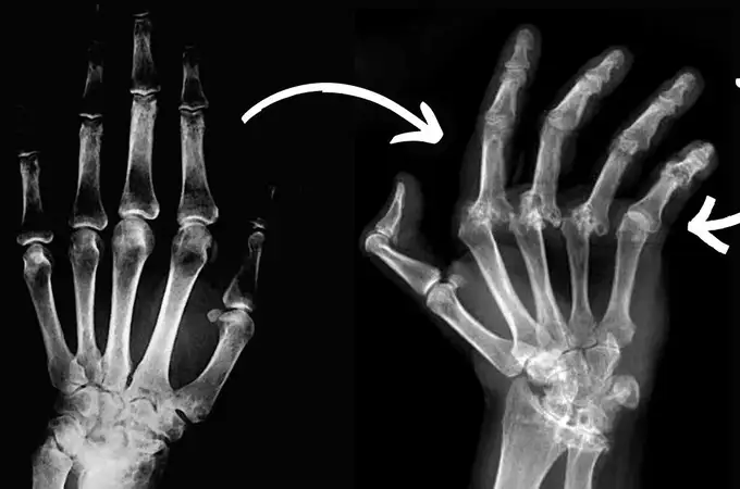 Descubren que un fármaco común mejora los síntomas de la artritis de manos