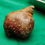 Extirpan con éxito la piedra del riñón más grande del mundo: casi 1 kilo