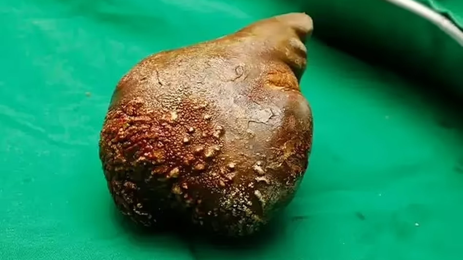 Extirpan con éxito la piedra del riñón más grande del mundo: casi 1 kilo