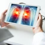 MADRID.-El Puerta de Hierro participa en una investigación española sobre cáncer de pulmón que eleva un 20% la supervivencia