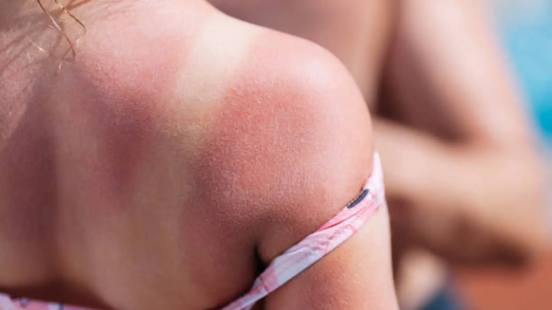 Espalda de una joven con una quemadura provocada por el sol