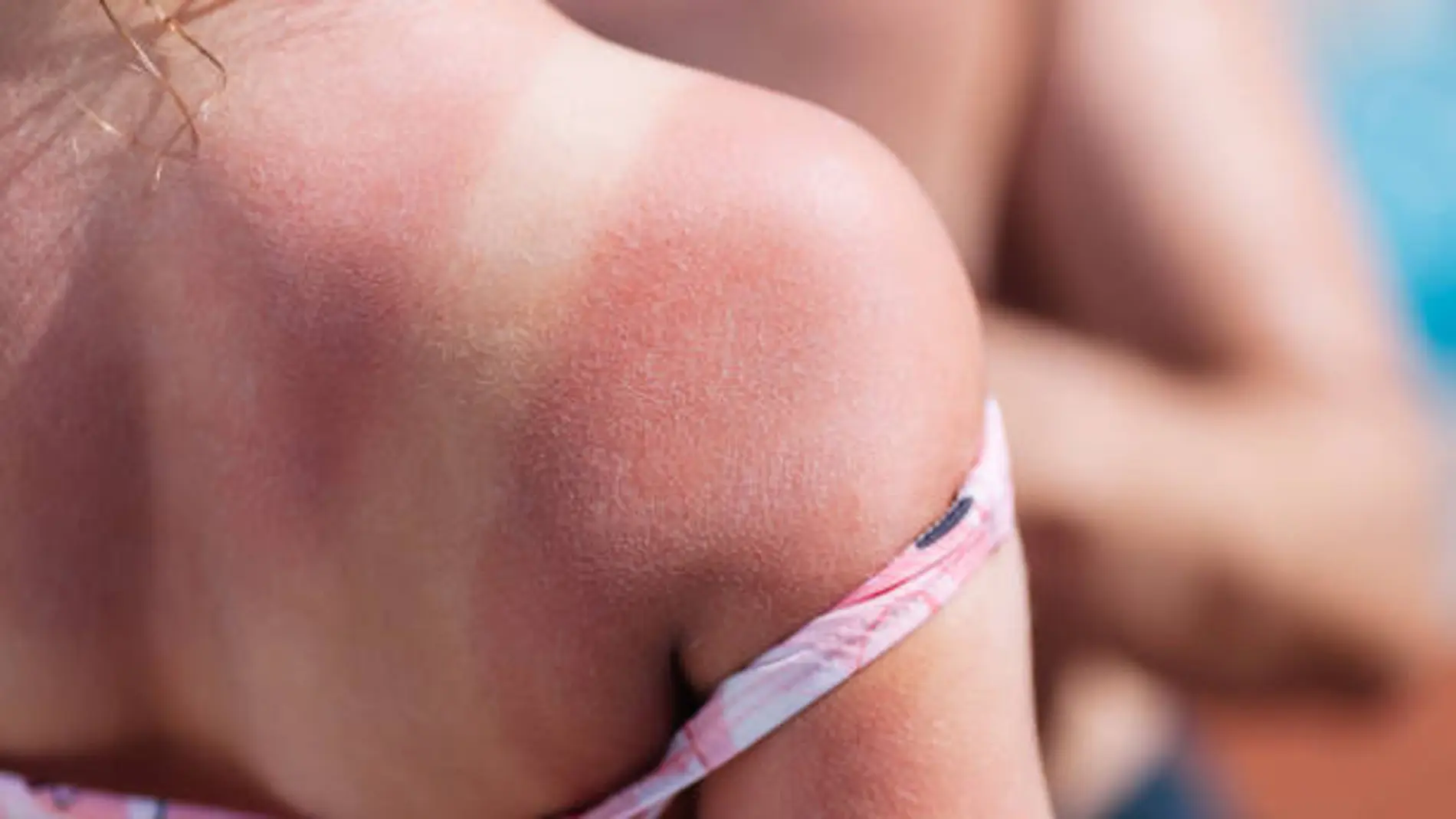 Por qué me pica la piel después de tomar el sol y cómo aliviarlo